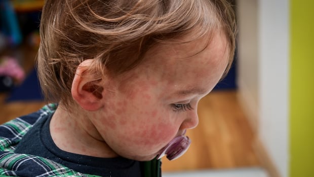 Must adolescence vaccination be obligatory? In line with a brand new pole, about 70% Canadians suppose so Must adolescence vaccination be obligatory? In line with a brand new pole, about 70% Canadians suppose so
