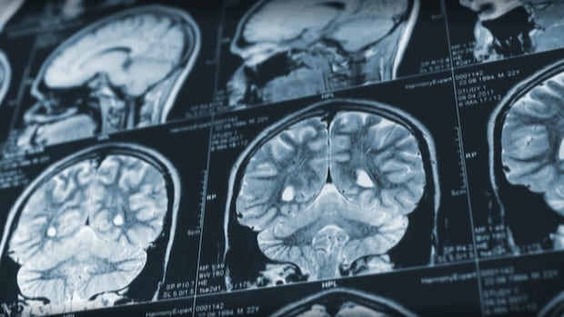 Patient advocate calls for retraction of mystery brain disease report from U.S. medical journal Patient advocate calls for retraction of mystery brain disease report from U.S. medical journal