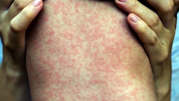 Out of measles control, ‘experts warns, as the Alberta case is more than 1,000 Out of measles control, ‘experts warns, as the Alberta case is more than 1,000