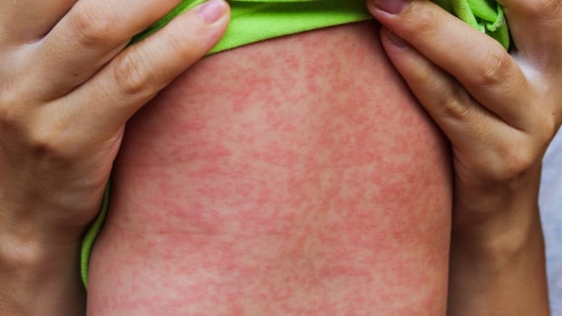 Ontario reported 12 new measles cases, the trend continues downwards Ontario reported 12 new measles cases, the trend continues downwards