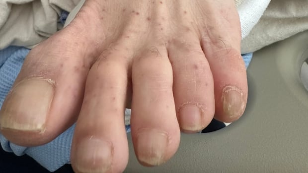 Tick-based Rocky Mountain saw a fever spread in Canada